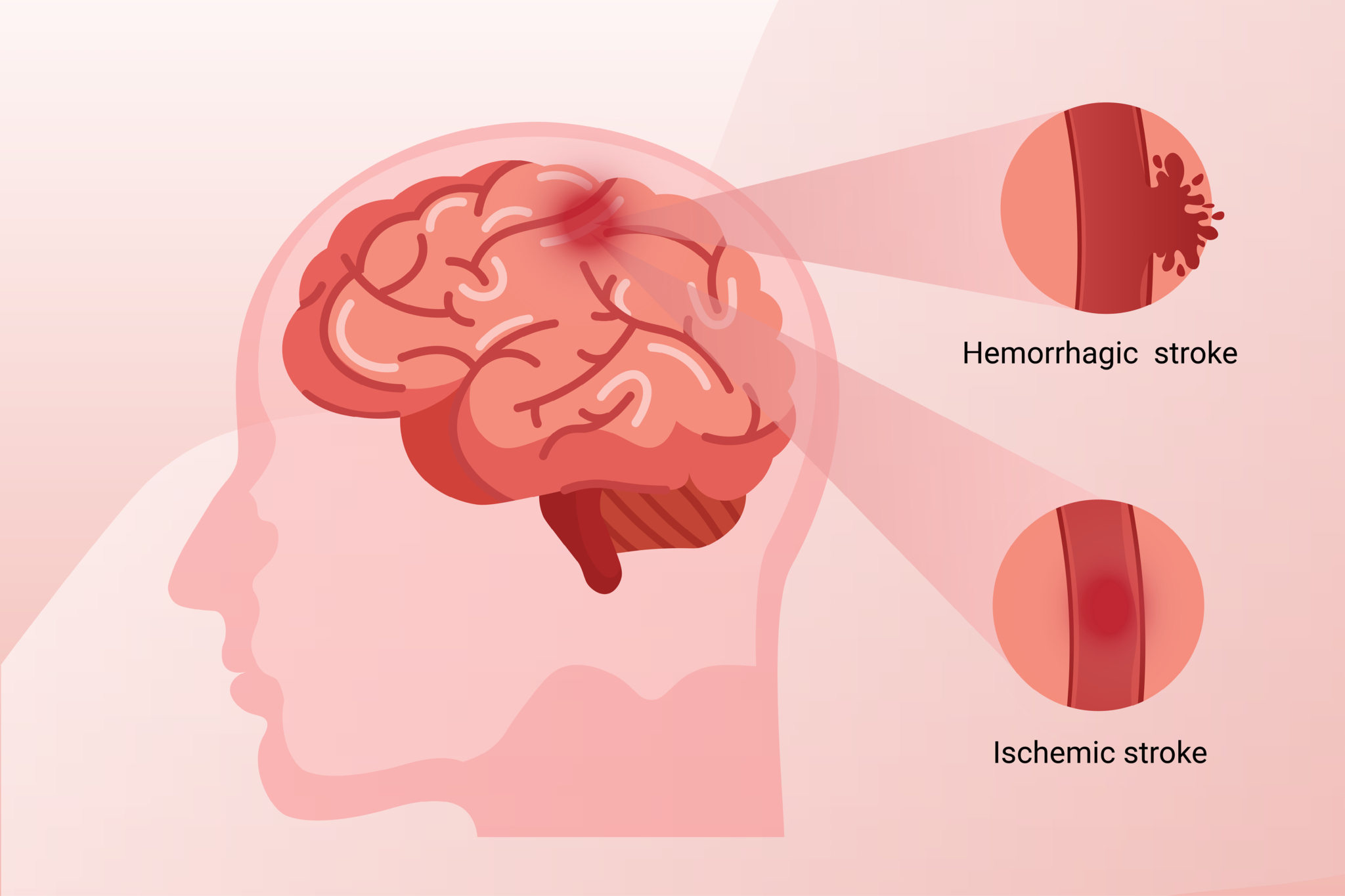 The Link Between Hypertension and Stroke Risk - A&D Medical